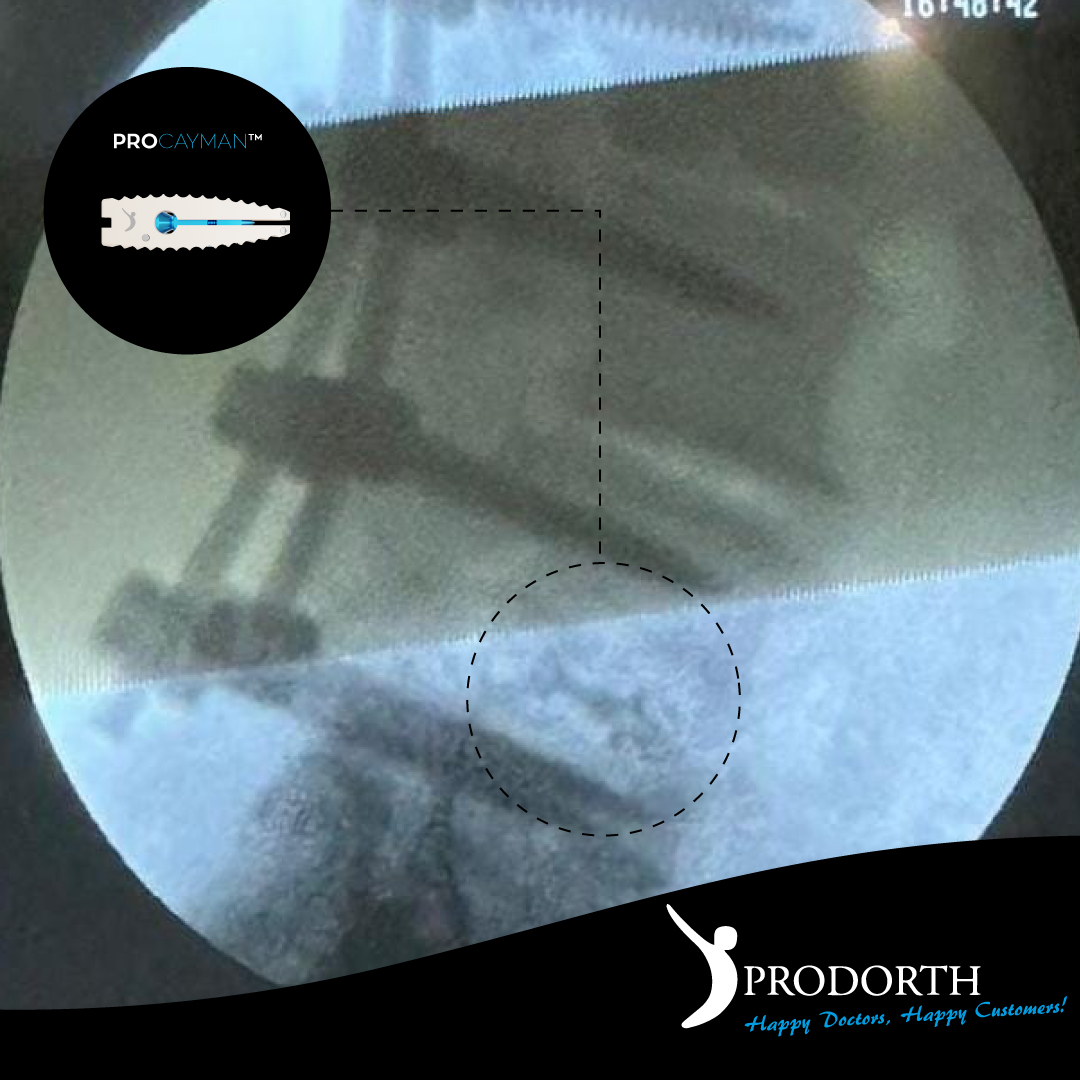 📌 Expandable PLIF PEEK Cage

🎯 PROCAYMAN™️

📍 Mexico

#prodorthspine #spinehealth #spinesurgery #spinedoctor #spinedevice #spineimplants #postoperative #thoracolumbarfusion #spinalfusionwarrior #lumbarcages #peekcage #plifpeekcage