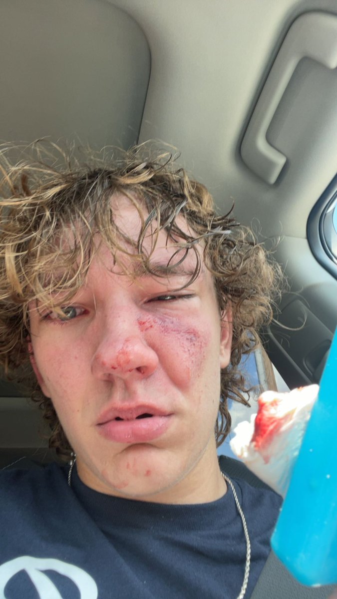 LukeHaney13's tweet photo. Won’t be able to post baseball recruiting clips for a while, have 3 fractures in the right nose and cheek bone from a baseball accident. https://t.co/q0mPU35ITJ