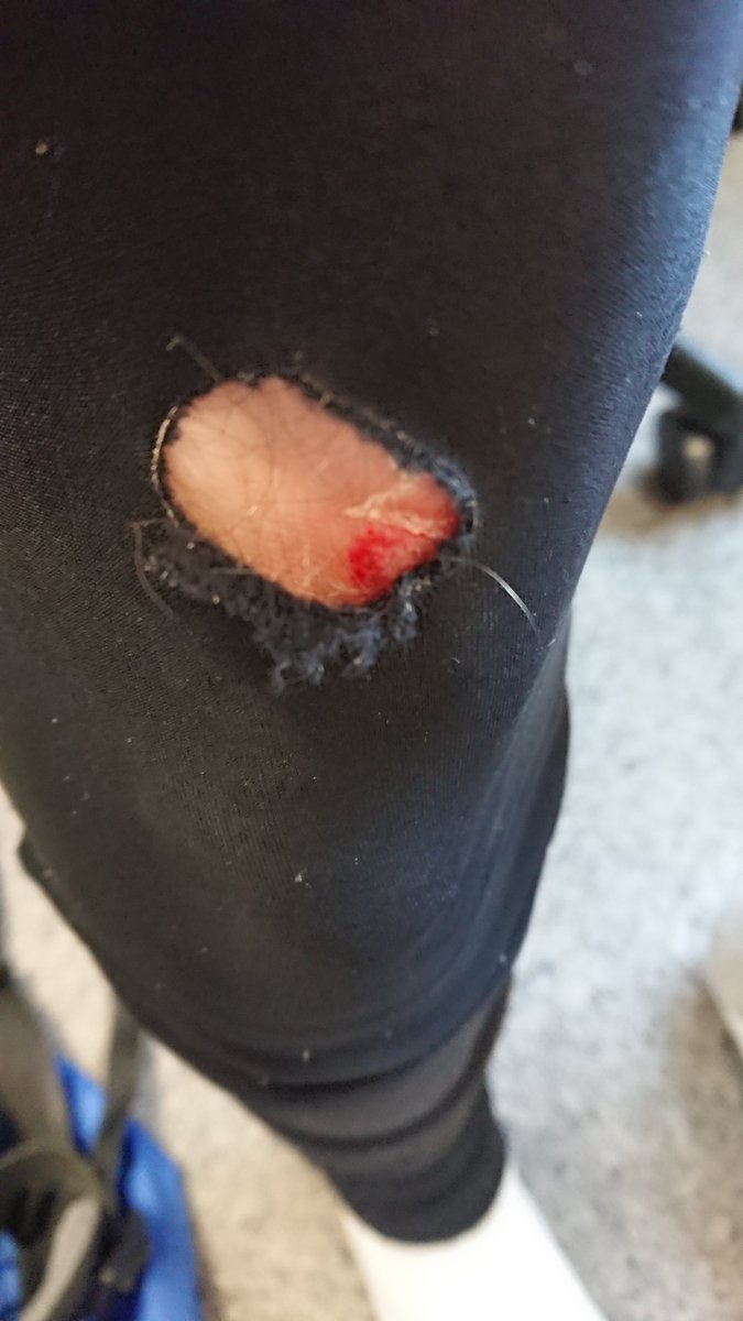 Matt Addicoat (@mattaddicoat) on Twitter photo I'm forty years old and came home from the first day of school with a skinned knee... 🙄 I'm forty years old and came home from the first day of school with a skinned knee... 🙄