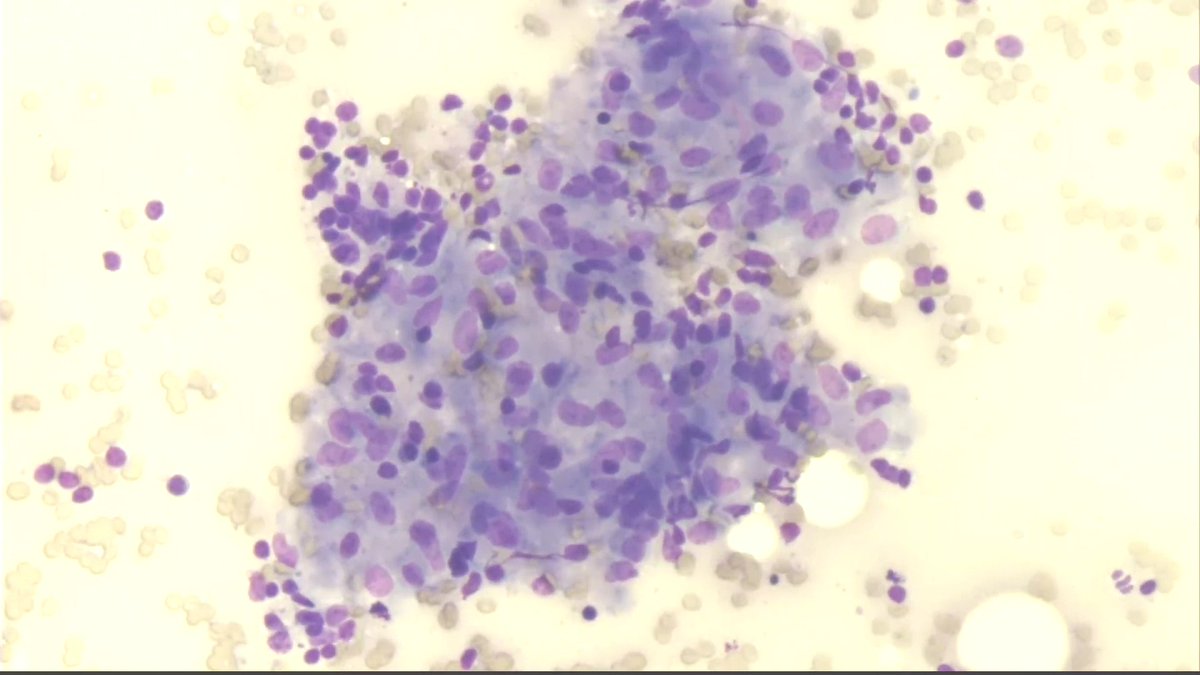 Melina Flanagan, MD, MSPH (@mbdflanaganmd) on Twitter photo WVU Path <a href="/WVUPathology/">WVU Pathology, Anatomy, and Laboratory Medicine</a> seeks an #Academic #Cytopathologist due to system growth. Practice #cytopath exclusively or w/ subspecialty #surgpath. #Telecytology #ROSE #Fellowship #Leadership opportunities. Work w/ me & our great team! #Morgantown #WV Interested? Reach out to me. WVU Path <a href="/WVUPathology/">WVU Pathology, Anatomy, and Laboratory Medicine</a> seeks an #Academic #Cytopathologist due to system growth. Practice #cytopath exclusively or w/ subspecialty #surgpath. #Telecytology #ROSE #Fellowship #Leadership opportunities. Work w/ me & our great team! #Morgantown #WV Interested? Reach out to me.