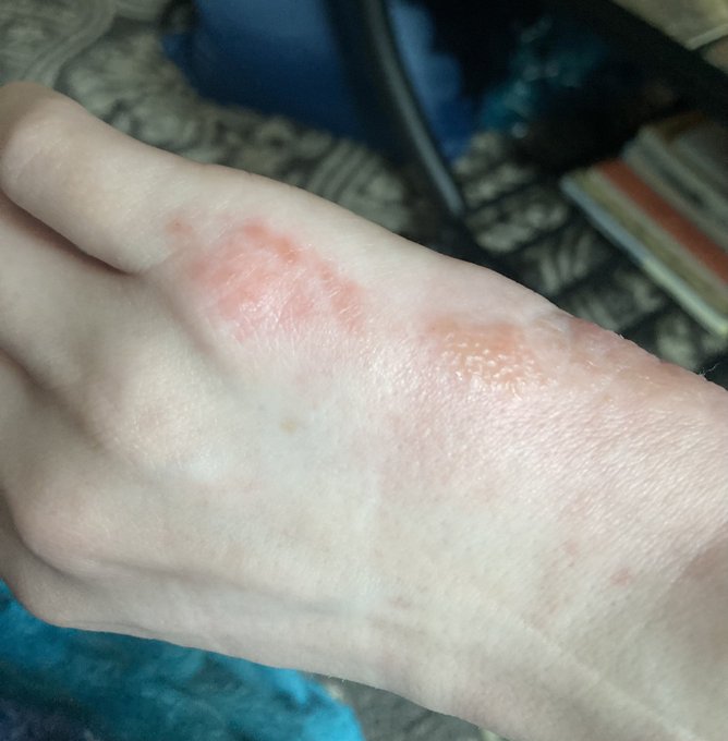 TRIGGER WARNING: INJURY/BURN  Who&rsquo;s got two thumbs and gave herself a first degree friction burn trying
