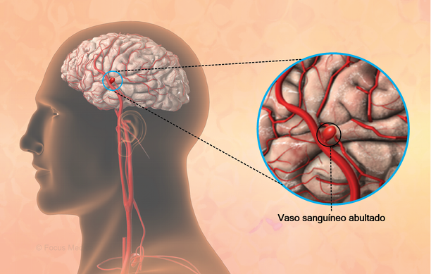 onaycu73's tweet photo. Aneurisma en el cerebro. 
Hinchazón o abultamiento de la arteria debido a debilidad en la pared del vaso que suministra sangre al cerebro.OLIFE INFUSIÓN DE HOJAS DE OLIVOS LISTA PARA CONSUMIR, https://t.co/uJEQv6Pffi https://t.co/7xw0gze4RM