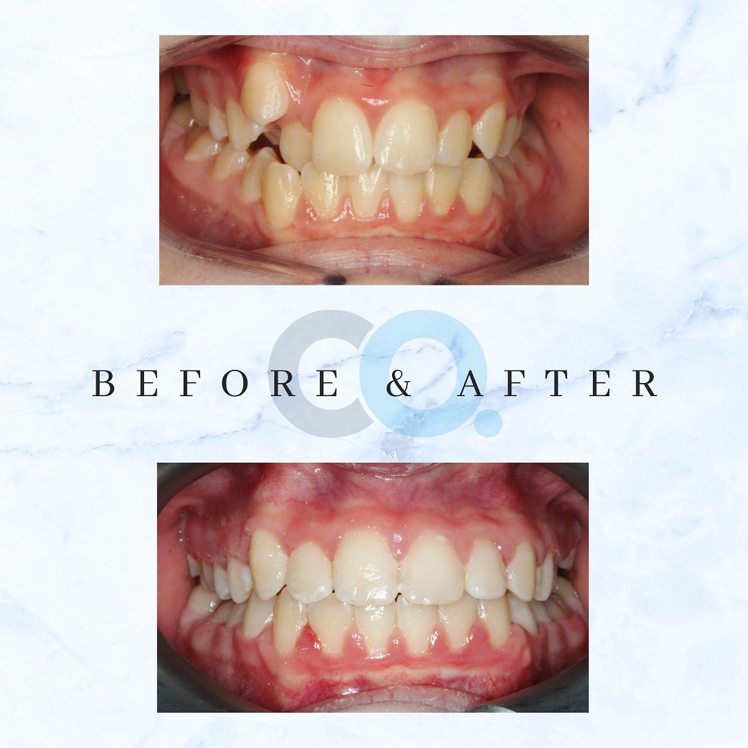 ConfidentOrtho's tweet photo. 🙌🏼 Witness this incredible Transformation 🙌🏼

Wow, our lovely patient has undergone an incredible before and after journey and we are beyond thrilled to share the amazing results 🎉
Just look at the fantastic result! We’re truly grateful to have been apart of this smile journey! https://t.co/EeTYpTesI6