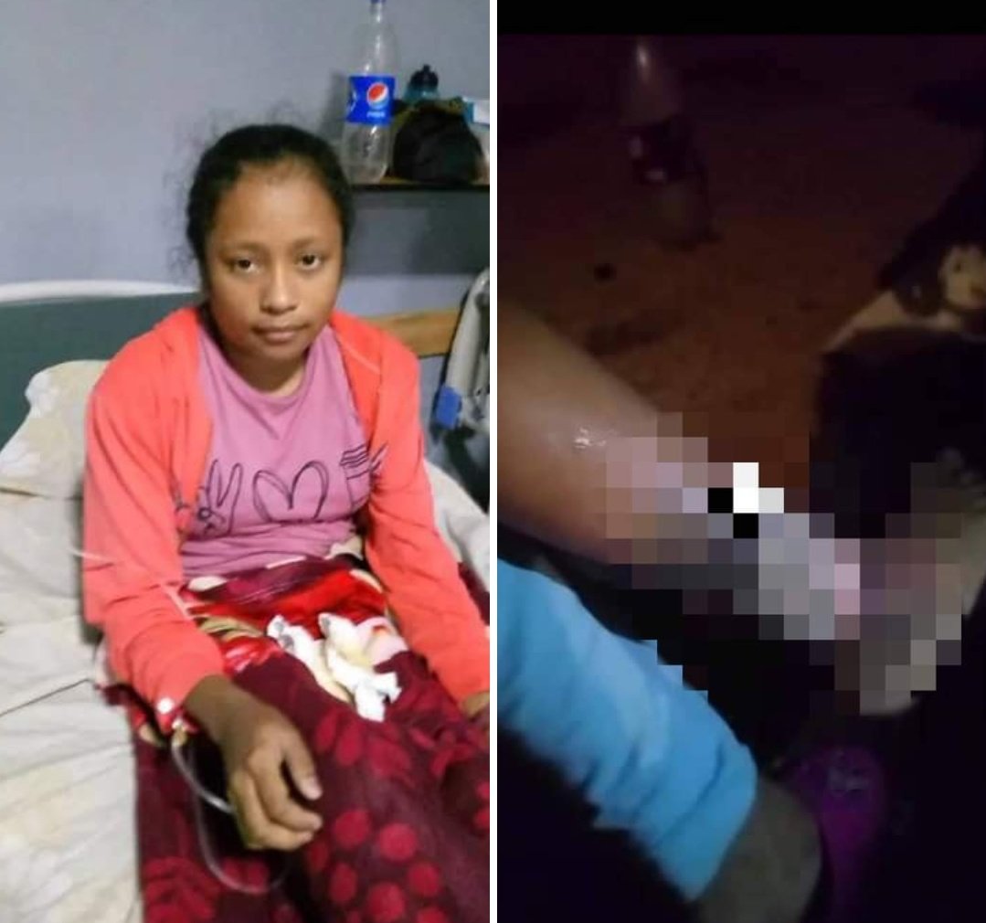 MariaGArocha's tweet image. En el hospital JM Casal Ramos se encuentra ésta jovencita de escasos recursos, sin poder cumplir tratamiento para la lesión por la bacteria leishmaniasis porque NO HAY INSUMOS!.

Mientras tanto, el gobernador ocupado con el concierto de #JessiUribe