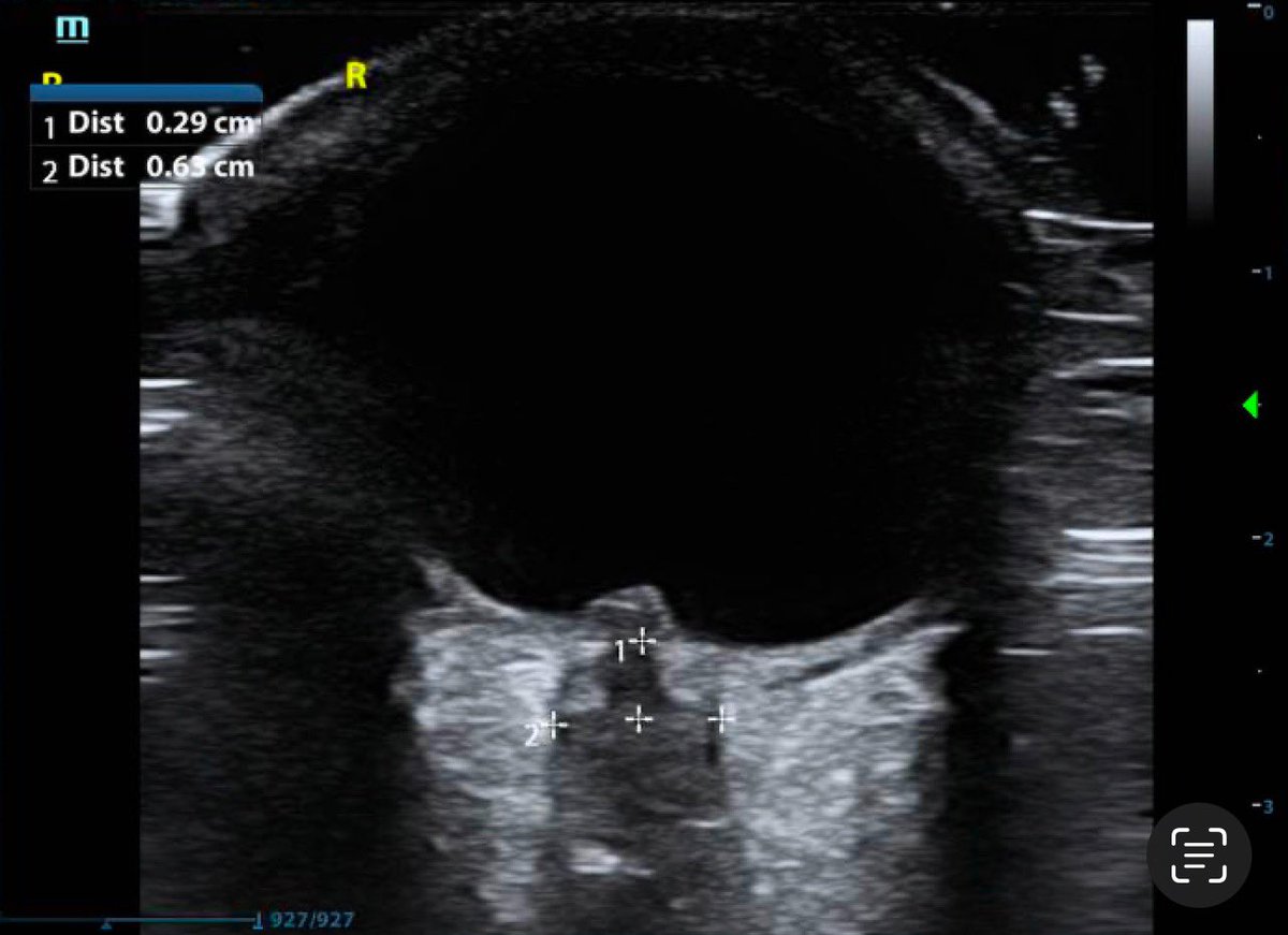 RutgersNJMS_POCUS (@rutgerspocus) on Twitter photo Hot tips for Ocular POCUS by <a href="/cooperali/">Ali Cooper</a>
- Use cold gel, it has more structural integrity to minimize applied pressure
- Brace scanning hand on patient's forehead to minimize pressure to globe
- “Ocular” setting is lower energy, minimizes potential damage to corneal epithelium Hot tips for Ocular POCUS by <a href="/cooperali/">Ali Cooper</a>
- Use cold gel, it has more structural integrity to minimize applied pressure
- Brace scanning hand on patient's forehead to minimize pressure to globe
- “Ocular” setting is lower energy, minimizes potential damage to corneal epithelium