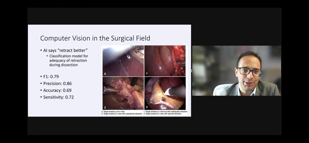 Divya Kewalramani, MD (@divvya20k) on Twitter photo Always a pleasure to listen to <a href="/aminmadaniMD/">Amin Madani MD PhD</a> share insights on Surgical AI. 🤖🩺 His expertise and passion shine through in every discussion.
<a href="/UHN/">University Health Network</a> <a href="/SAGES_Updates/">SAGES is in Tampa in 2026!</a> <a href="/Surgical_AI/">Global Surgical AI Collaborative</a> Always a pleasure to listen to <a href="/aminmadaniMD/">Amin Madani MD PhD</a> share insights on Surgical AI. 🤖🩺 His expertise and passion shine through in every discussion.
<a href="/UHN/">University Health Network</a> <a href="/SAGES_Updates/">SAGES is in Tampa in 2026!</a> <a href="/Surgical_AI/">Global Surgical AI Collaborative</a>