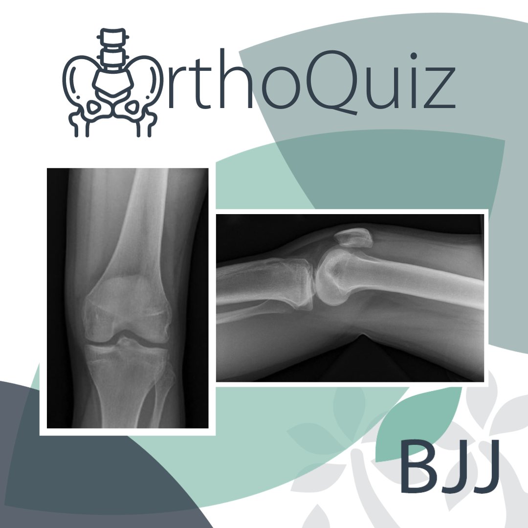 BoneJointJ's tweet photo. 🦴 ORTHOQUIZ ✨

A 19-year-boy old presents with a history of a painful left knee after a fall from a height of about five to six feet.

What is the diagnosis and how would you classify this fracture?

#OrthoQuiz #KneeInjury #Trauma #OrthoTwitter #BJJ https://t.co/JkE64ySHYK