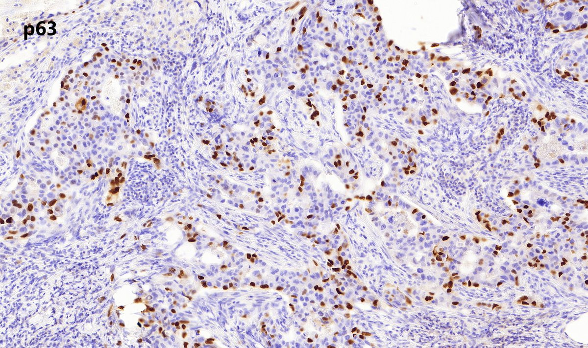 Breast, adult

Immunohistochemistry for p63

#Breastpath #PathX #pathresidents #pathtwitter