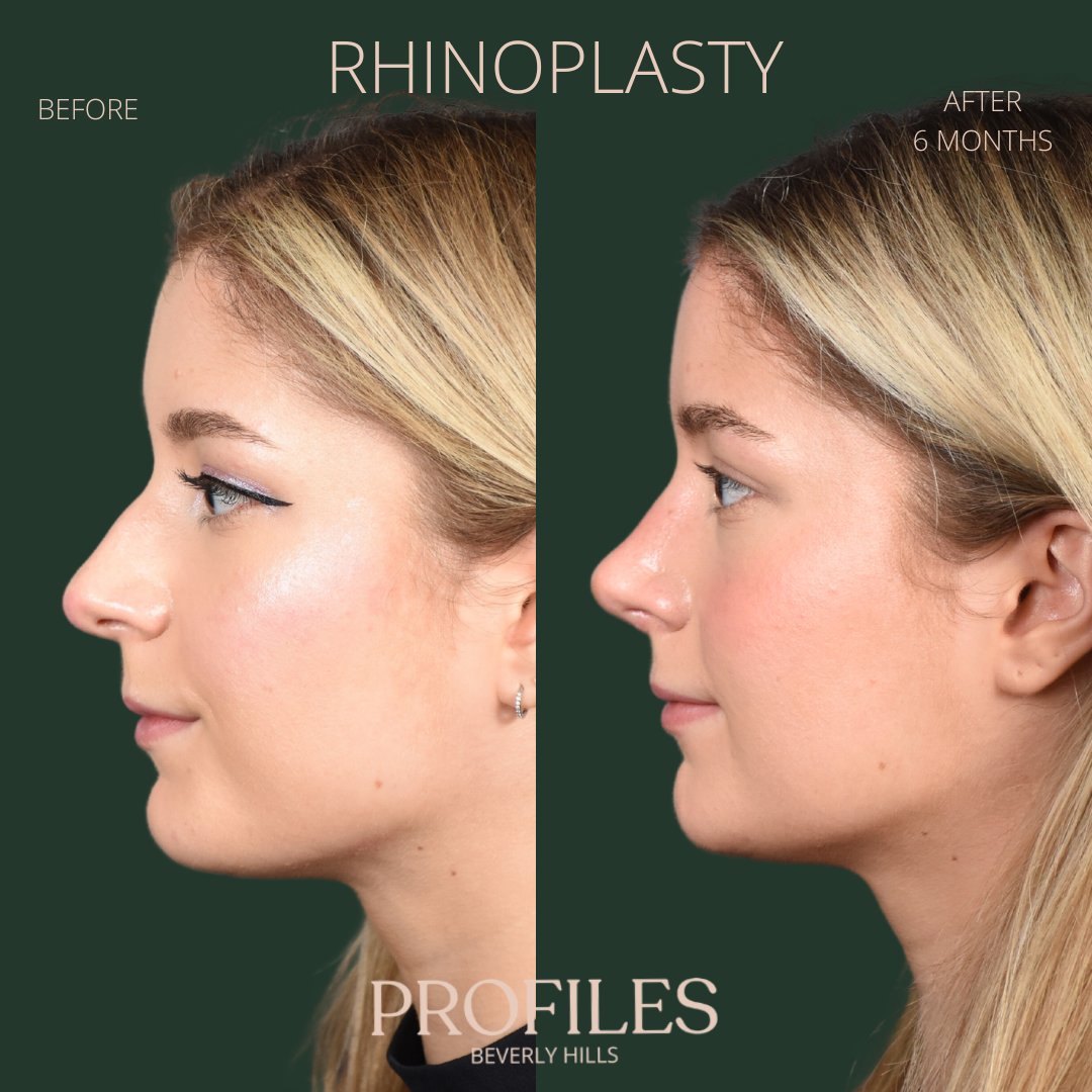 FacialPlastics's tweet photo. 📞310-276-6800
🏠 435 N Bedford Drive, PH500, Beverly Hills, 90210
👃Rhinoplasty
🗓 Before and After 6 Months
🛏 About 1 week, the cast gets taken off after 6 days

Swipe ⏩⏩⏩ for more views

Call or DM us to schedule your consultation

We also offer virtual co... https://t.co/vXwQS254eM