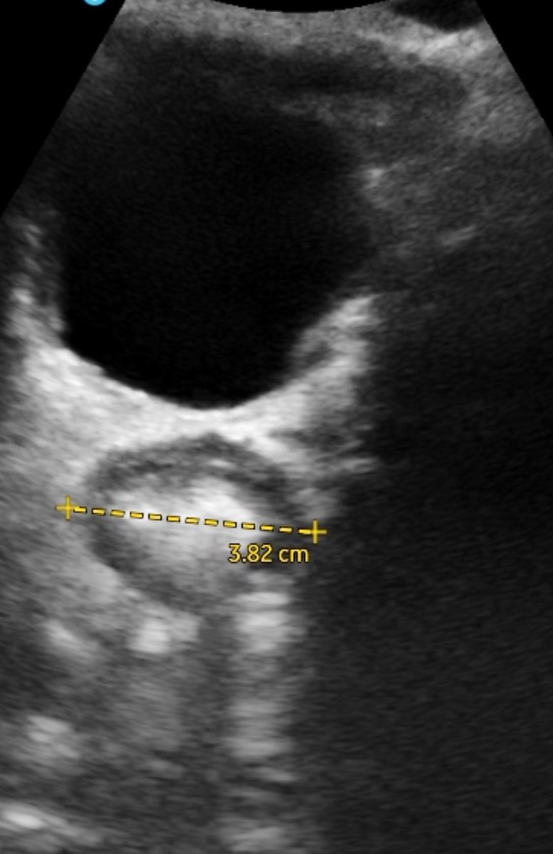Working on trans-abdominal rectal #ultrasound skills with a new Vscanair probe. 
✅ quick at the bedside
✅ no radiation
👉can replace DRE in many cases
😁shows progress!
This kid is still somewhat #constipated but the rectal diameter has decreased from 7.2cm-&gt;3.8cm! #pedsgi