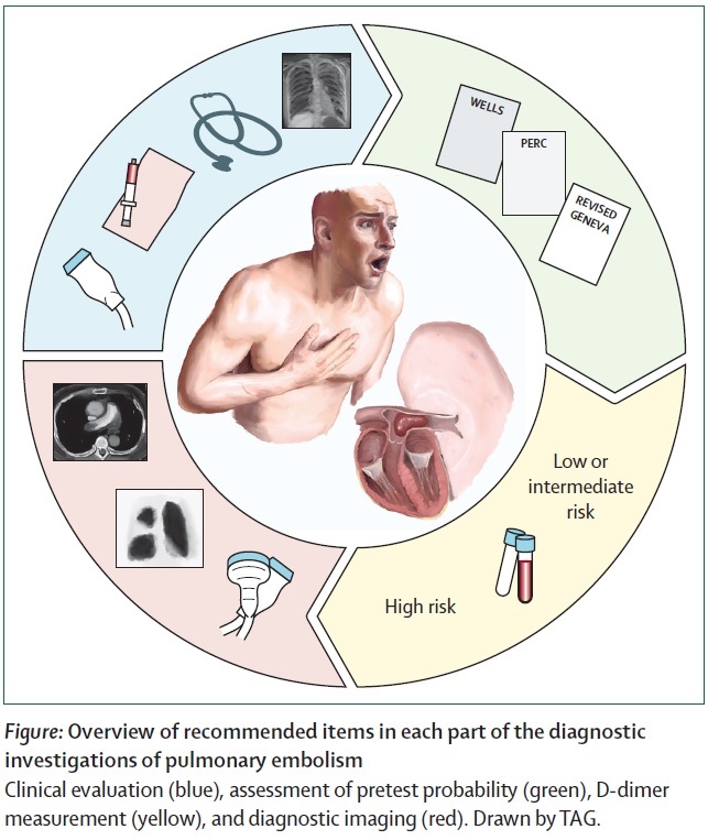 13 international guidelines provide recommendations on pulmonary embolism... #VTE #PE #thrombosis

This Review compares guidelines on each facet of the diagnosis of pulmonary embolism and provides a synthesis on the most common recommendations thelancet.com/journals/lanha…
