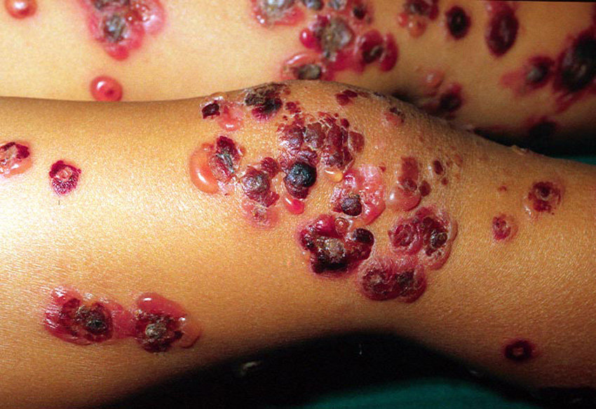 MoreXGrok's tweet photo. A child with sepsis

 👉treated with multiple courses of antibiotics including intravenous vancomycin

Developed these lesions 

Diagnosis? https://t.co/SsarksyKxO