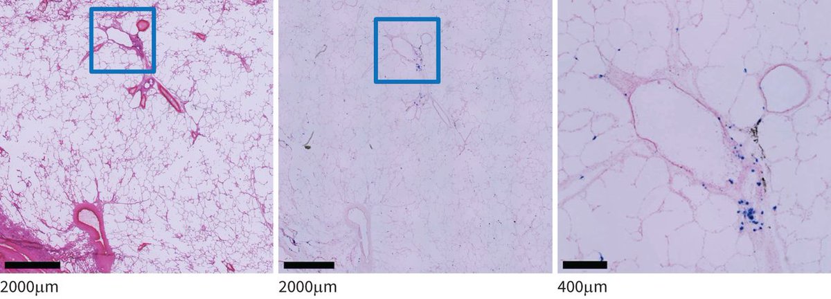 ERSpublications's tweet photo. ERJOR: Blood eosinophil count was associated with eosinophils observed in small airways of lung specimens in smokers with and without COPD. The blood eosinophil count may reflect eosinophilic inflammation in small airways. https://t.co/Gk6PiBcOe3 https://t.co/Dt7ktbQvEi