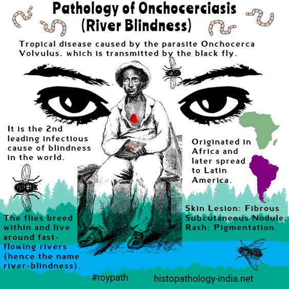 schowardjd's tweet photo. @Path4People I am . . . Onchocerca volvulus!

Onchocerciasis ("River Blindness")

Mass drug administration w/ ivermectin

(image credit: @DrSampyRoy, #RoyPath, https://t.co/25dThNlFfJ) https://t.co/BSN66SUsJM