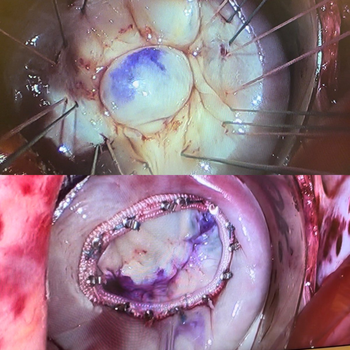 AshVMD's tweet photo. Absolutely love taking on the challenge of minimally invasive mitral valve repair! 🫀💙 It’s a blend of art and science that brings hope and healing to patients. #HeartHealth #MinimallyInvasiveSurgery #MitralValveRepair #SternumSparing https://t.co/aReyAmiP4c