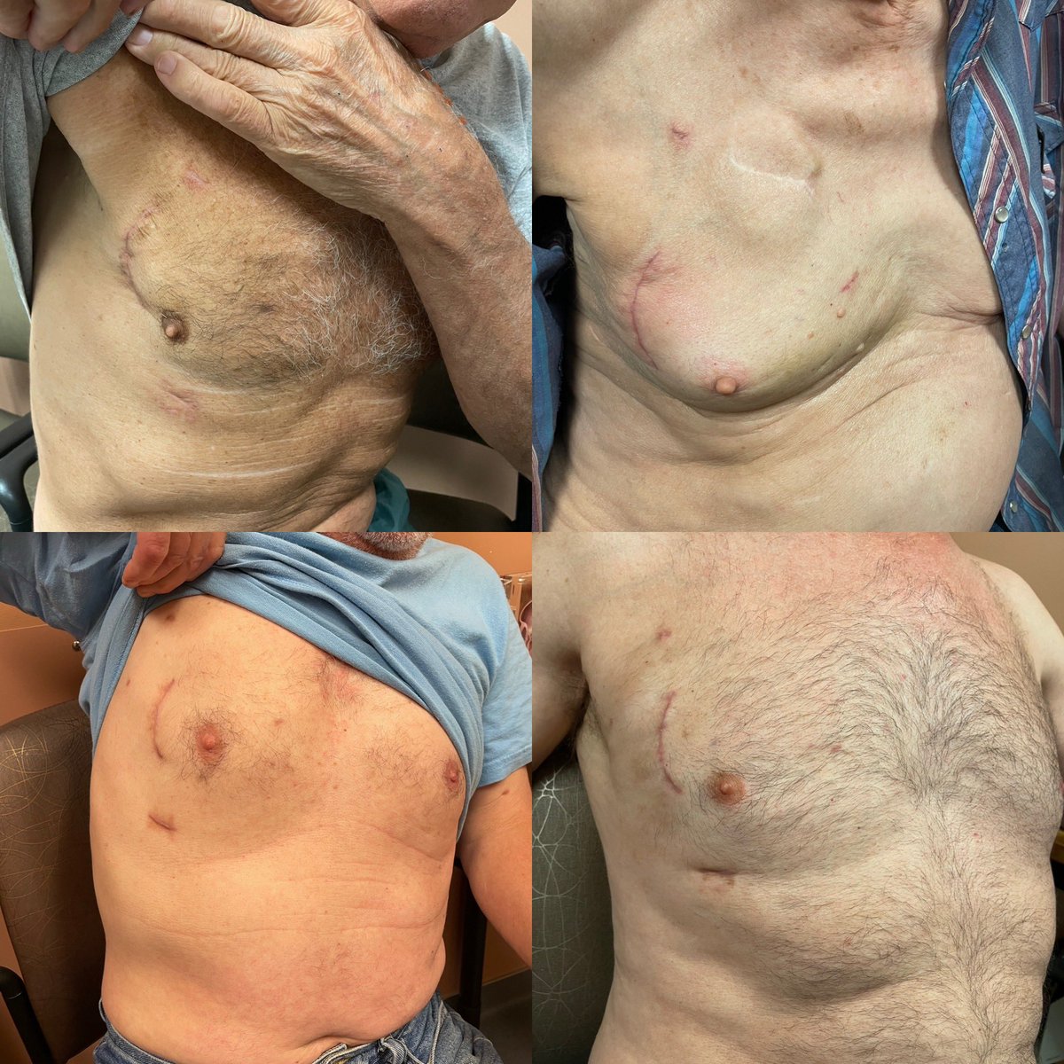 AshVMD's tweet photo. Absolutely love taking on the challenge of minimally invasive mitral valve repair! 🫀💙 It’s a blend of art and science that brings hope and healing to patients. #HeartHealth #MinimallyInvasiveSurgery #MitralValveRepair #SternumSparing https://t.co/aReyAmiP4c