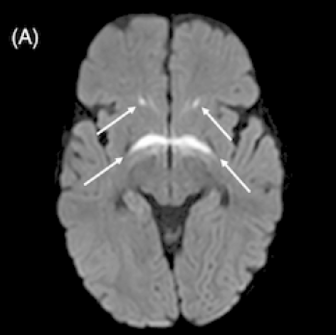 JIMD_Editors's tweet photo. See the associated image and read the full report here: https://t.co/xhL9KOqw8R 

#SciComm #raredisease #podcastepisode #inheritedmetabolicdisease #InbornErrorsOfMetabolism #Homocystinuria https://t.co/MJof22VdKF