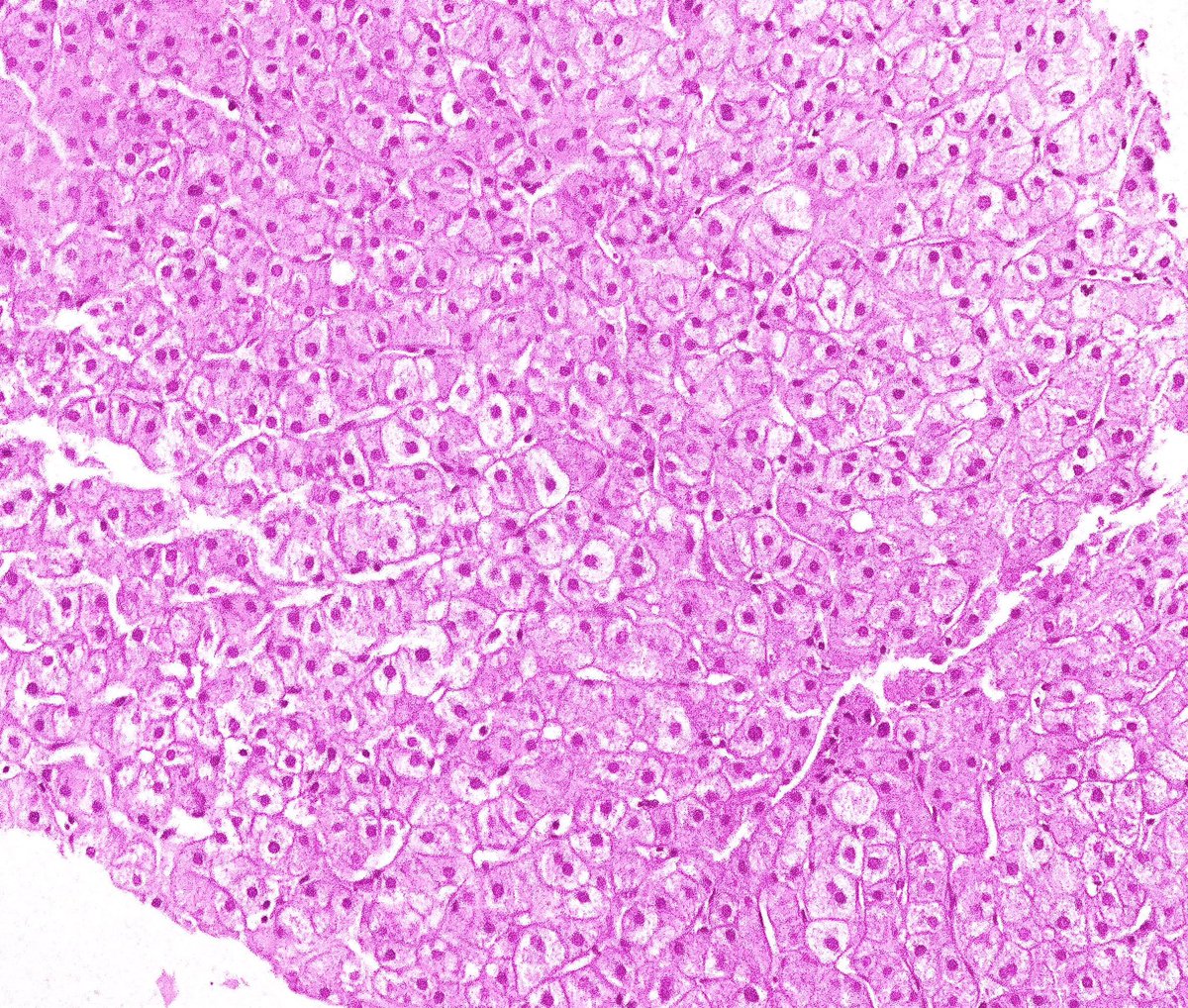 👉🏻Glycogen storage disease
Mosaic pattern
Enlarged hepatocytes with plant-cell like morphology & pale cytoplasm 
Prominent cell membranes due to displacement of cell organelles by glycogen to cell periphery
#PathTwitter #pedipath #pathology