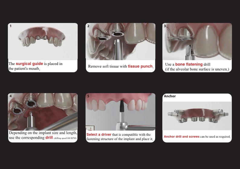 csmimplant's tweet photo. CSM IMPLANT Digital Kit
#manufacturing #manufacturer #dentalimplants #implant #implantkorea #csmimplant #manufacturerkorea https://t.co/tX9MbGszHB
