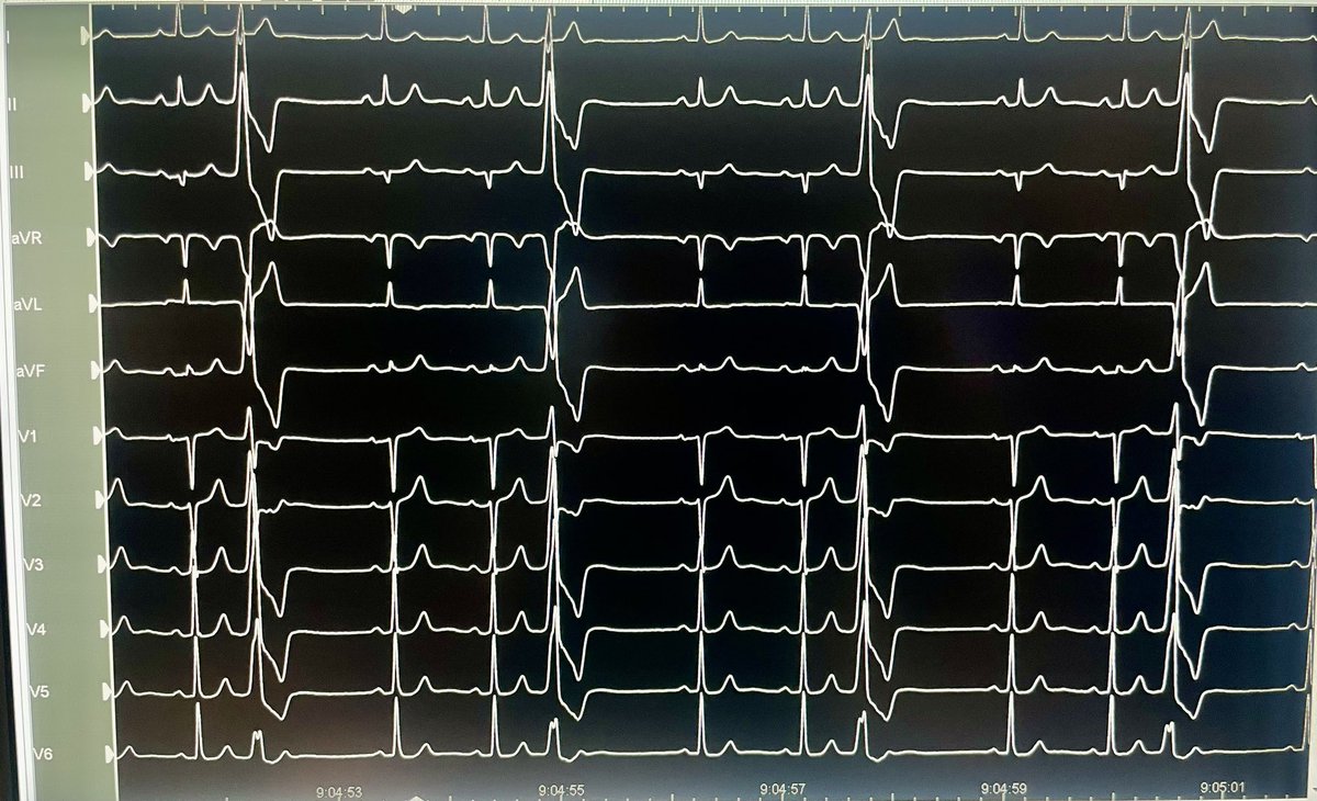 Dra_Jaurrigan's tweet photo. Single-catheter, 30-min procedure to CURE a patient with high-density LVOT (LCC)-PVCs. “Simplicity is the ultimate sophistication”. Kind reminder: Refer your patients to the EP lab! #ablatePVCs #EPeeps https://t.co/bugZtPxMyX