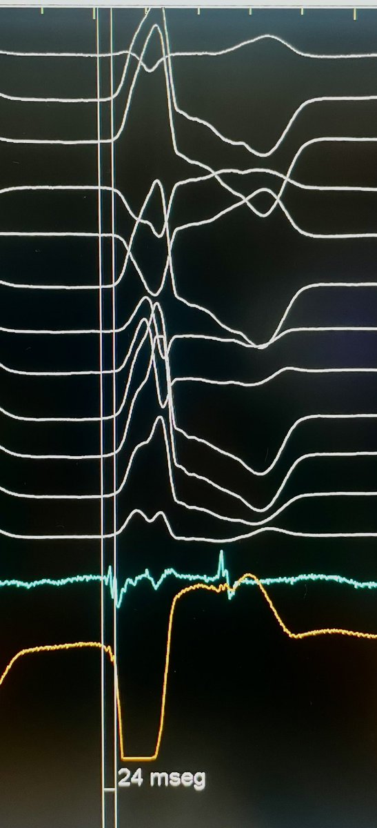 Dra_Jaurrigan's tweet photo. Single-catheter, 30-min procedure to CURE a patient with high-density LVOT (LCC)-PVCs. “Simplicity is the ultimate sophistication”. Kind reminder: Refer your patients to the EP lab! #ablatePVCs #EPeeps https://t.co/bugZtPxMyX