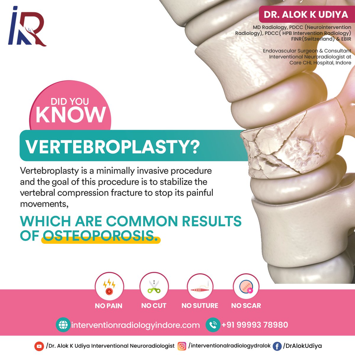 Vertebroplasty is often an outpatient procedure used to treat painful compression fractures in the spine. For More Information Consult Dr. Alok Udiya  +91 99993 78980 #vertebroplasty #scoliosis #cervicalpain #interventionalradiologist #dralokudiya #painmanagement #backpain #spine