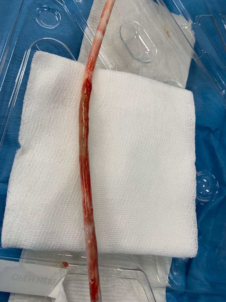 Staph Aureus Sepsis in patient Cuffed tunneled HD catheter.  #Hemodialysis #VascularAccess
