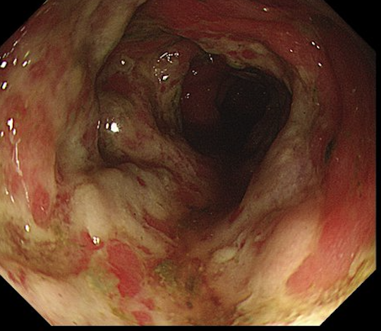 Sociedad Española de Patología Digestiva (SEPD) tweet media