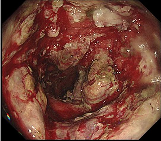 Sociedad Española de Patología Digestiva (SEPD) tweet media