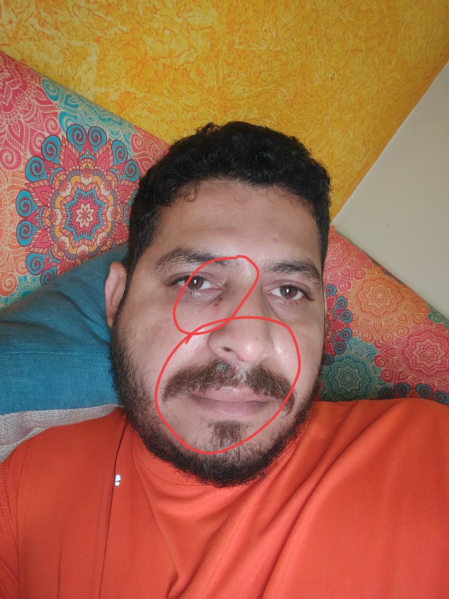 _techibee's tweet photo. What's up #Techibeefam, I hope everyone is doing well. I have not been active for the past few days because recently been diagnosed with herpes, which has resulted in pain and swelling on my face. (1/2) https://t.co/aP4x88sEwI