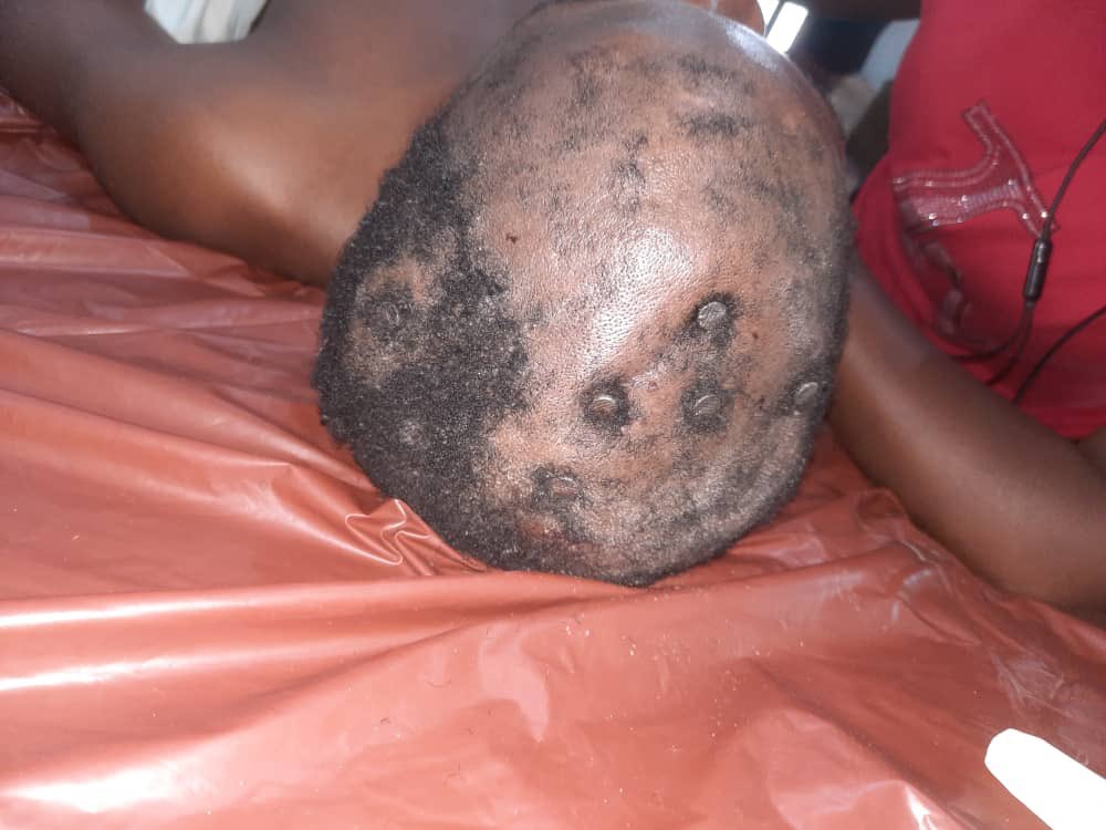 drpenking's tweet photo. UPDATE
This Nigerian man that had 7 nails driven into his skull by a rival cult group yesterday is now conscious, alert and communicating . Everybody in the health team is shocked. This is one of the so called Medical Miracles. I guess this is God giving him a second chance. https://t.co/DhOQ4vhxLi