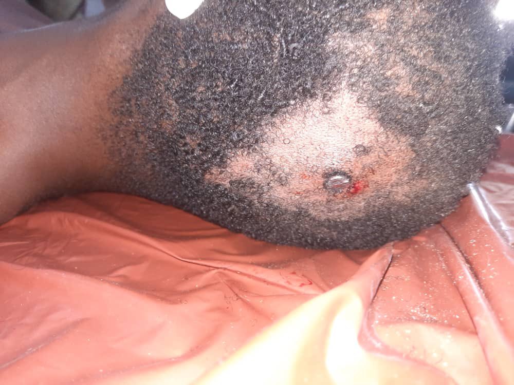 drpenking's tweet photo. UPDATE
This Nigerian man that had 7 nails driven into his skull by a rival cult group yesterday is now conscious, alert and communicating . Everybody in the health team is shocked. This is one of the so called Medical Miracles. I guess this is God giving him a second chance. https://t.co/DhOQ4vhxLi