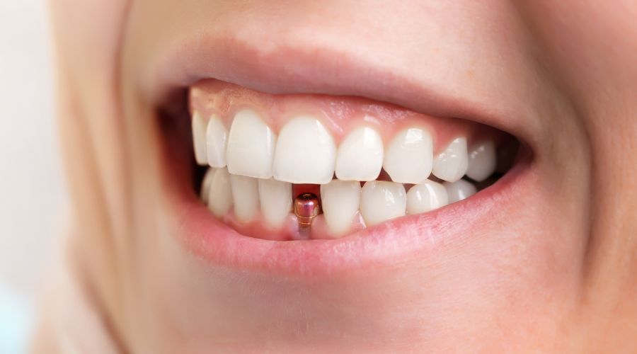 أدق طريقة لزراعة الأسنان في دبي وأبو ظبي
#زراعةالأسنان
#زراعةالأسنانفيدبي
#أفضلزراعالأسنانفيدبي
royalclinicdubai.com/ar-ae/the-most…
تعتبر إدراجات الأسنان حلاً تدريجيًا للأسنان المفقودة.