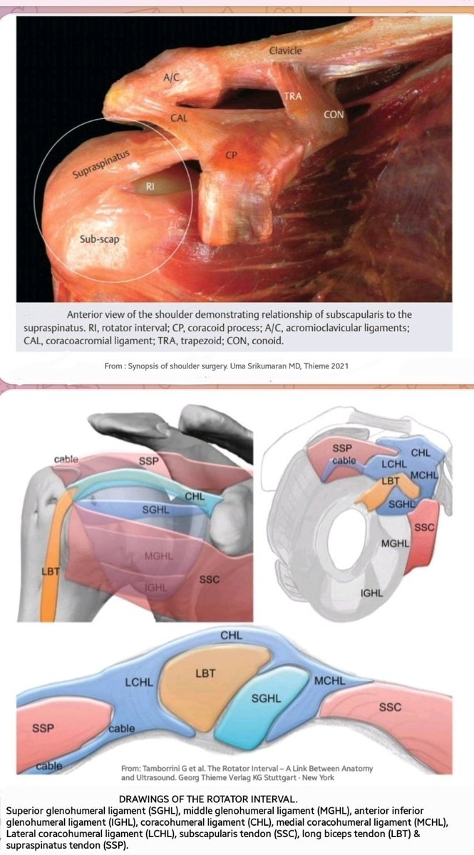 Dr. OMID BANDARCHI (@obandarchi) on Twitter photo The illustration & photograph wonderfully showing ROTATOR INTERVAL (RI).👍RI is a triangular space in ant part of Rotator Cuff (RC).Many authors claim RI prevent excessive inf/post humeral head translation. Others say RI as area of tissue deficiency&if injured lead to instability The illustration & photograph wonderfully showing ROTATOR INTERVAL (RI).👍RI is a triangular space in ant part of Rotator Cuff (RC).Many authors claim RI prevent excessive inf/post humeral head translation. Others say RI as area of tissue deficiency&if injured lead to instability