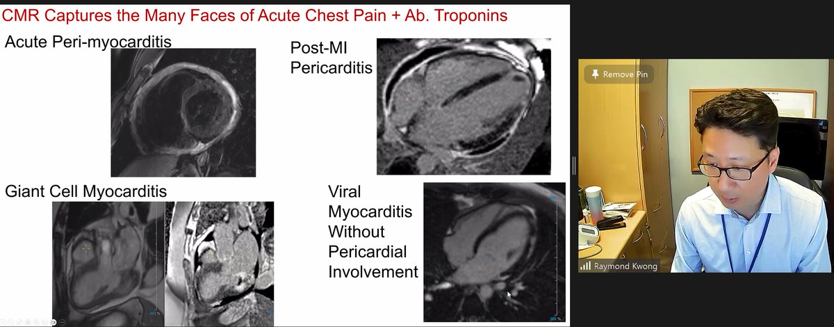 @ShehabAnwer @RKwongMD @BrighamWomens @RadiologieUSZ @rmanka_ @Alkadhi_rad @SCMRorg @CotSwiss @VDelgadoGarcia @FGraziani_Grace @saramoscatelli7 @ErsozluSara @JGrapsa @echo_stepbystep @s_e_petersen @Unispital_USZ @DQBM_uzh @SABOURETCardio @shafeeq_moham @BWHCVImaging @harvardmed @EACVIPresident @CTECresearch @herznetz @YoungDgk @SwissCardio In addition, #WhyCMR captures many faces of acute #ChestPain & abnormal #Troponins

#BioTechX #CardioTwitter @RadiologieUSZ
@rmanka_
@Alkadhi_rad
@BrighamWomens
@imagingssc
@SwissCardio
@DjawidHashemi
@CotSwiss
@DGK_org
@SwissCardio
@CardiologyToday
@imagingtoronto
@SCMRorg