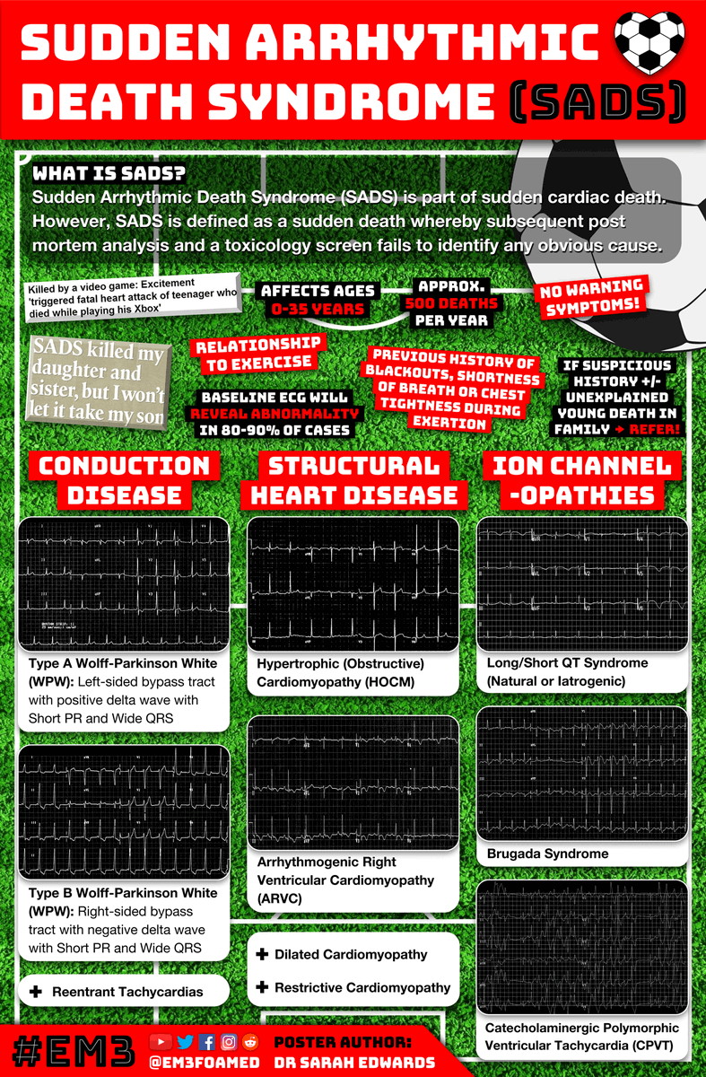 To help emergency clinicians recognise the cardiac signs of Sudden Arrhythmic Death Syndrome when patients attend hospital 🏥🚑 we've produced a poster with @drsarahedwards for @JHMTorguk that demonstrates some typical ECGs to be mindful of 📈 #SADSweek2023