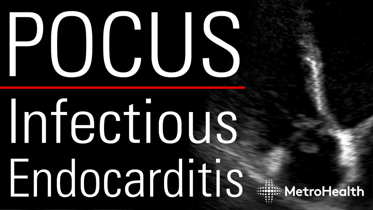 MetroHealth Emergency Ultrasound (@mh_emultrasound) on Twitter photo Check out our latest video about POCUS for Infectious Endocarditis by <a href="/mtabbut/">Matt Tabbut, MD</a>.
youtu.be/L2etxN0r0Y4
#MetroEUS #POCUS #ultrasound Check out our latest video about POCUS for Infectious Endocarditis by <a href="/mtabbut/">Matt Tabbut, MD</a>.
youtu.be/L2etxN0r0Y4
#MetroEUS #POCUS #ultrasound