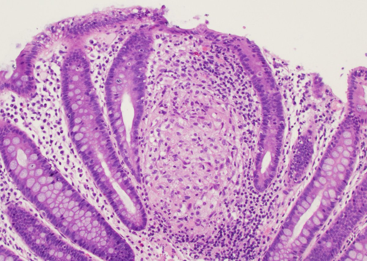 Non-necrotizing epithelioid granuloma in a patient with Crohn's disease.

#pathmatch2024 #pathology #pathresidents #GIpath