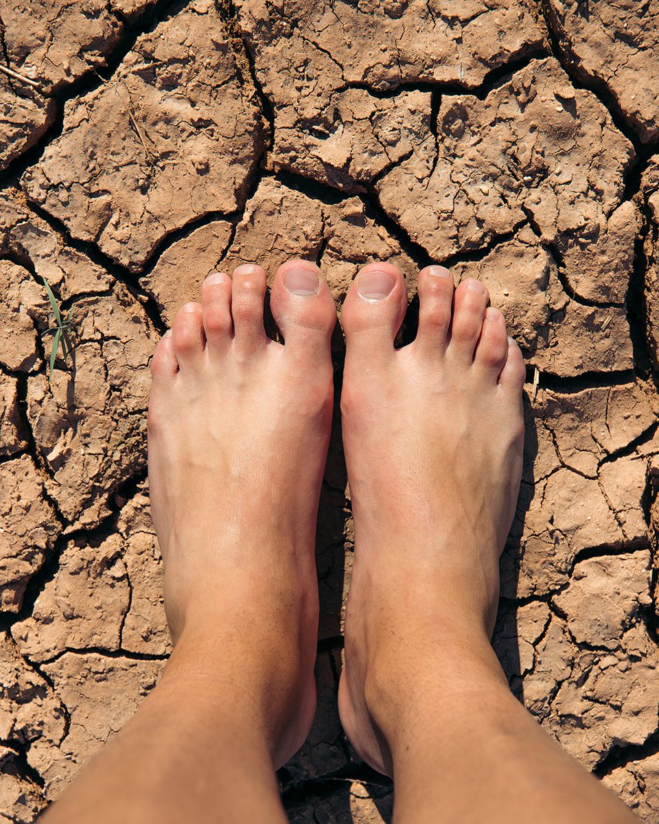 Have you experienced athlete’s foot? 🌵 If you’re wandering the cracked, scaling, and itchy feet desert, an orange oasis is on the horizon. 😉