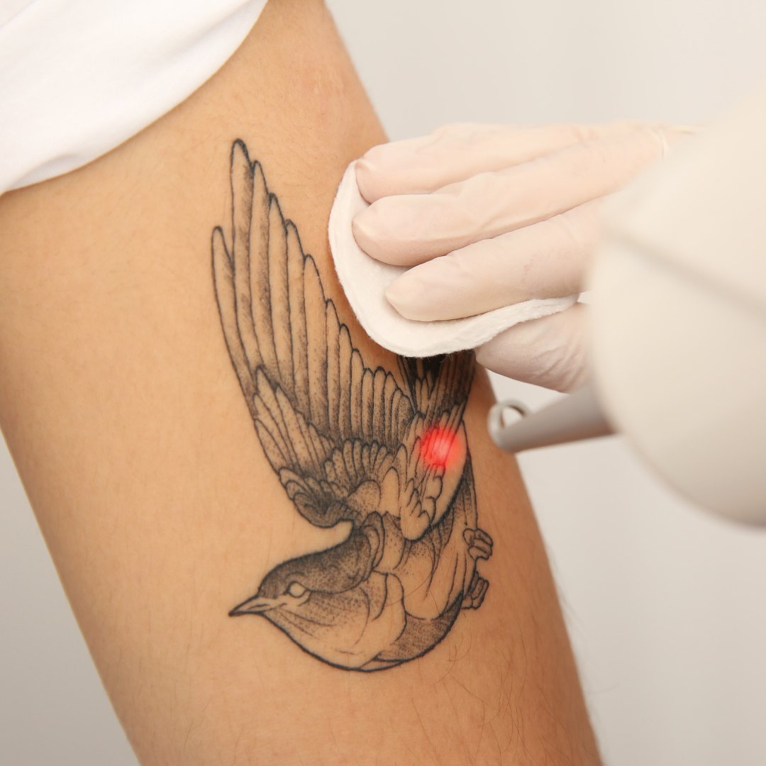 6 Things Everyone Gets Wrong About Laser Tattoo Removal

Read on: 1l.ink/4Z7MRS6

#AdvancedCosmeticSurgeryandLaserCenter #351Face #Botox #CosmeticSurgeon #Cincinnati #Ohio #PlasticSurgeon #MedicalSpa #Skincare #Injectables #LaserTreatments #EyelidSurgery #Blepharoplasty