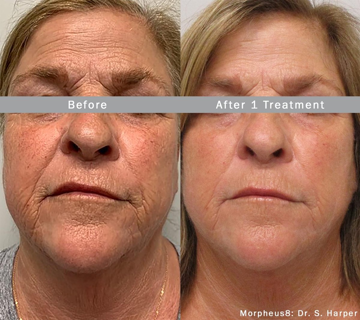 TheNovusCenter's tweet photo. Scare Those Wrinkles Away with our Morpheus8 Halloween Special! 🎃
Learn about all this revolutionary skin healing & tightening treatment:
https://t.co/LDXhkK6psG
#Morpheus8 #SkinTightening #LosAngeles #LABeauty #BeautyCare #Morpheus8Treatment #BioBeauty #collagen https://t.co/DBIwqaz7Kc
