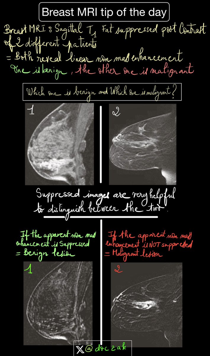doczak's tweet photo. Breast mri tip of the day : learn a useful sequence to distinguish between benign and malignant lesions 
#BreastCancerAwareness 
#breastmri 
#radiology 
#foamrad
#tipoftheday https://t.co/wHgP9z9pqU