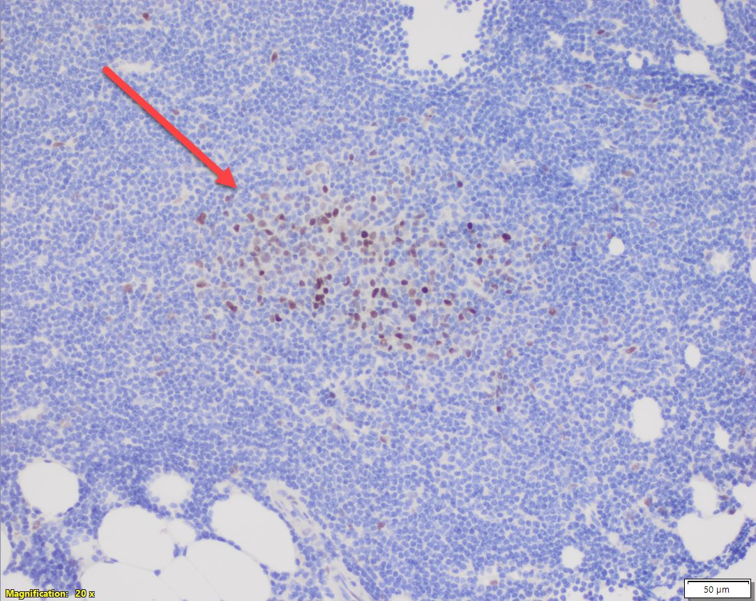 #hemepath #lymsm pitfall 🚨 CLL proliferation centers typically show uprgularion of cyclin D1. Don’t confuse this w/ mantle cell lymphoma. There is no CCND1-r. Read more about CLL w/ proliferation centers in the BM in our paper in @Human_Pathology sciencedirect.com/science/articl…