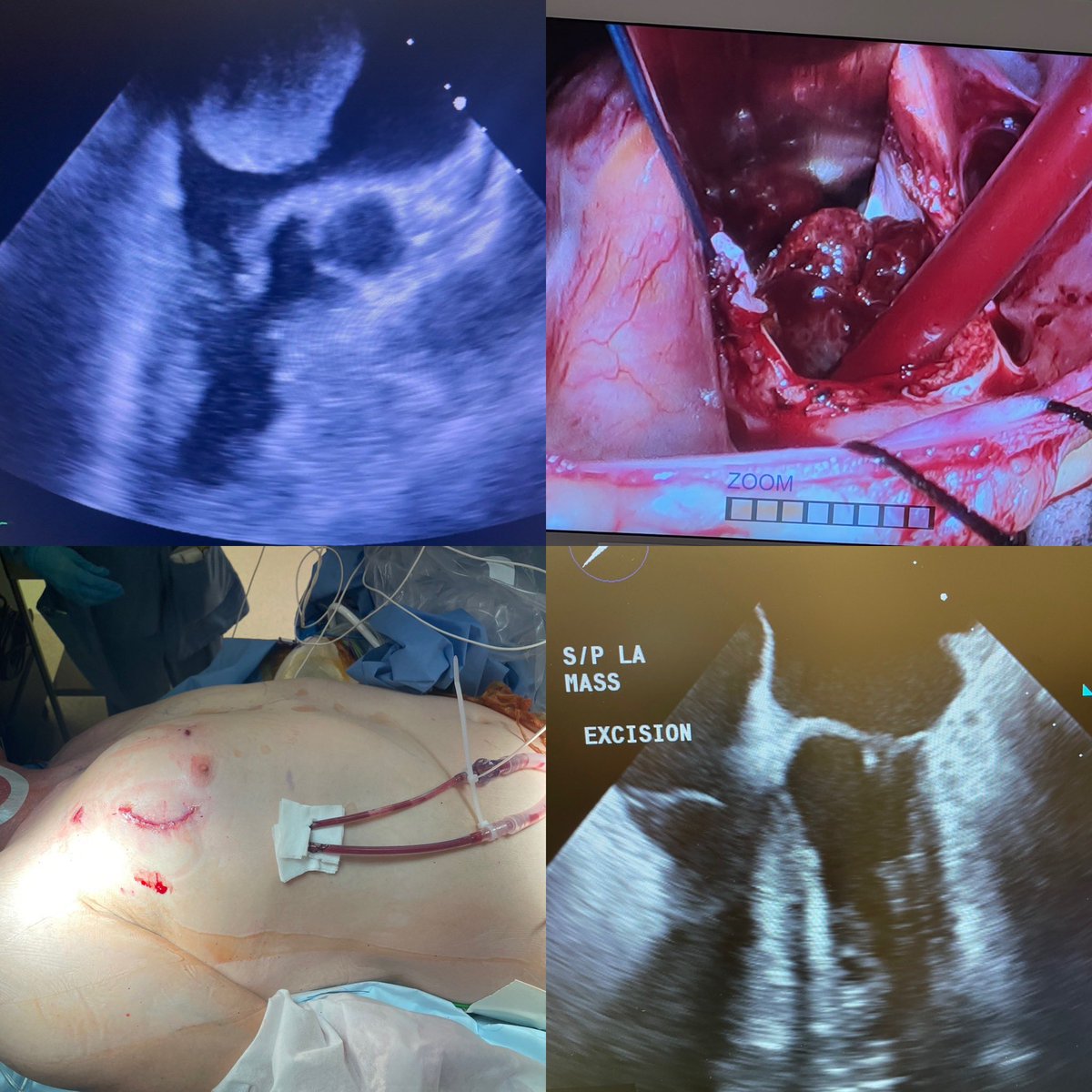 AshVMD's tweet photo. Pushing our boundaries in minimally invasive cardiac surgery #MICS with a left atrial myxoma resection and a postoperative day 4 discharge. #cardiacsurgery #echo #myxomas https://t.co/JVKD0LOpyx