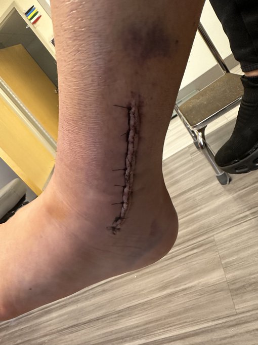 BUSTED ANKLE UPDATE AHEAD   (( Also hi! How are we doing? Who are we loving today? Who are we hating<a href="/tag/vettech"class="tags"><span>#vettech</span></a><a href="/tag/vettechlife"class="tags"><span>#vettechlife</span></a><a href="/tag/derrythepig"class="tags"><span>#derrythepig</span></a><a href="/tag/thepiggiest"class="tags"><span>#thepiggiest</span></a>