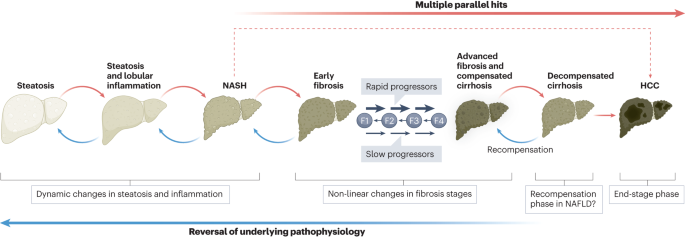 rabataller's tweet photo. Remember that the first objective in a patient with decompensated cirrhosis is achieving RECOMPENSATION.

This great article in @NatRevGastroHep reviews the mechanisms of recompensation in fatty liver.

@VirginiaHdezGea @GiadaSebastiani #livertwitter
https://t.co/8NJgSpWJne https://t.co/gAG8byDysB