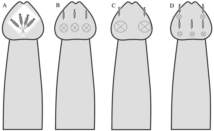 IJIR: Your Sexual Medicine Journal (@yoursexmedjour) on Twitter photo Surgical treatment of #prematureejaculation: a narrative review 👉rdcu.be/dnRZq
<a href="/docctoore/">Doç. Dr. Murat Gül</a> <a href="/drserefoglu/">Ege Can Serefoglu</a> Surgical treatment of #prematureejaculation: a narrative review 👉rdcu.be/dnRZq
<a href="/docctoore/">Doç. Dr. Murat Gül</a> <a href="/drserefoglu/">Ege Can Serefoglu</a>
