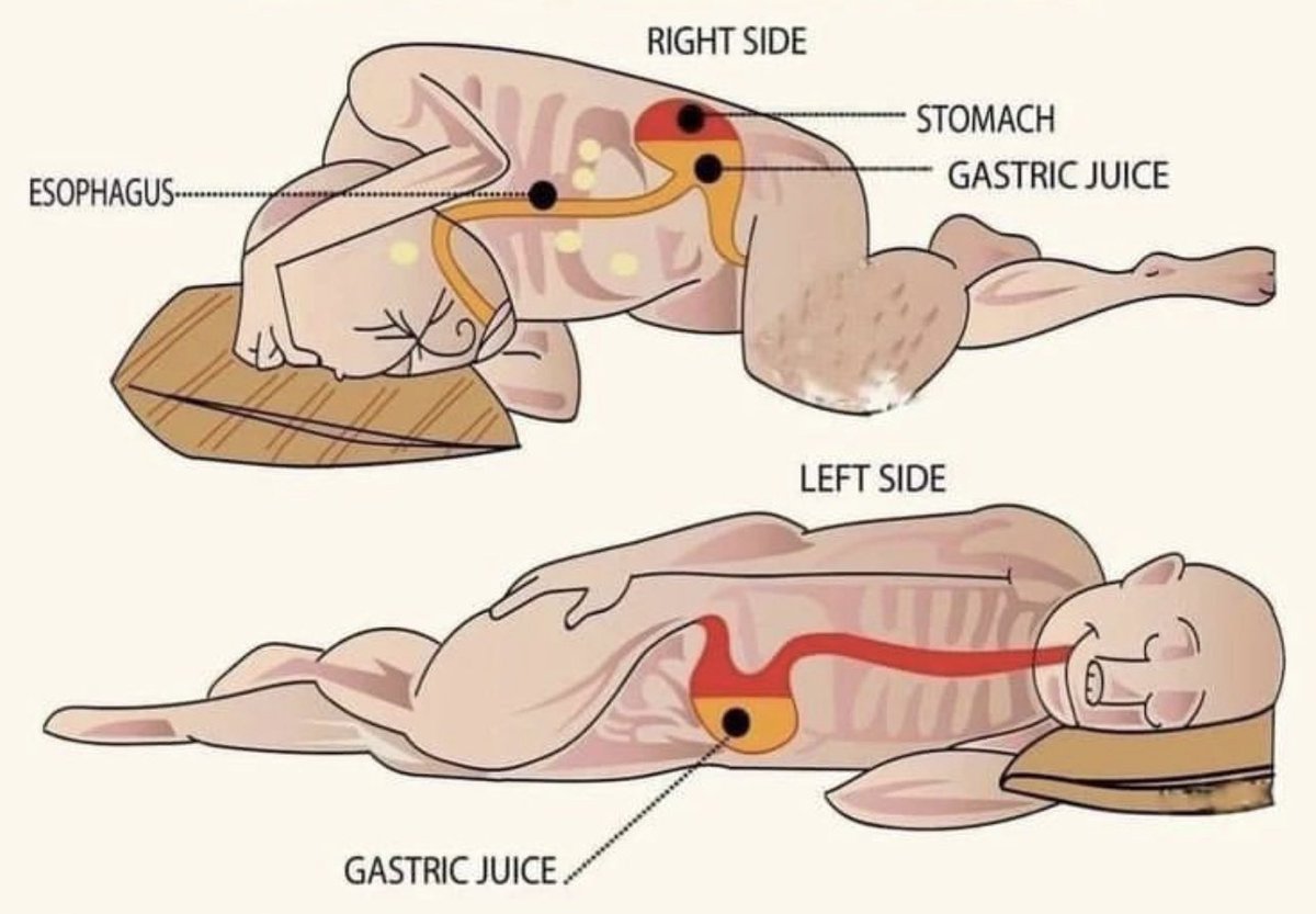themedicalvidzs's tweet photo. If you have reflux, normalize sleeping on your left side regularly. This can be as effective as taking an antacid medication. Repost: for others. https://t.co/m7PbxuwMmk