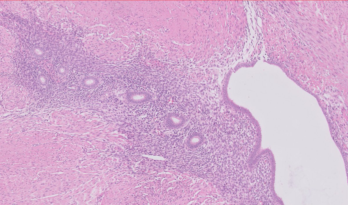 RyCPatologia's tweet photo. ➡️ Mujer, sigmoidectomía.
☑️ Endometriosis transmural.
#GIpath #rycpath https://t.co/ppZgaf21dt