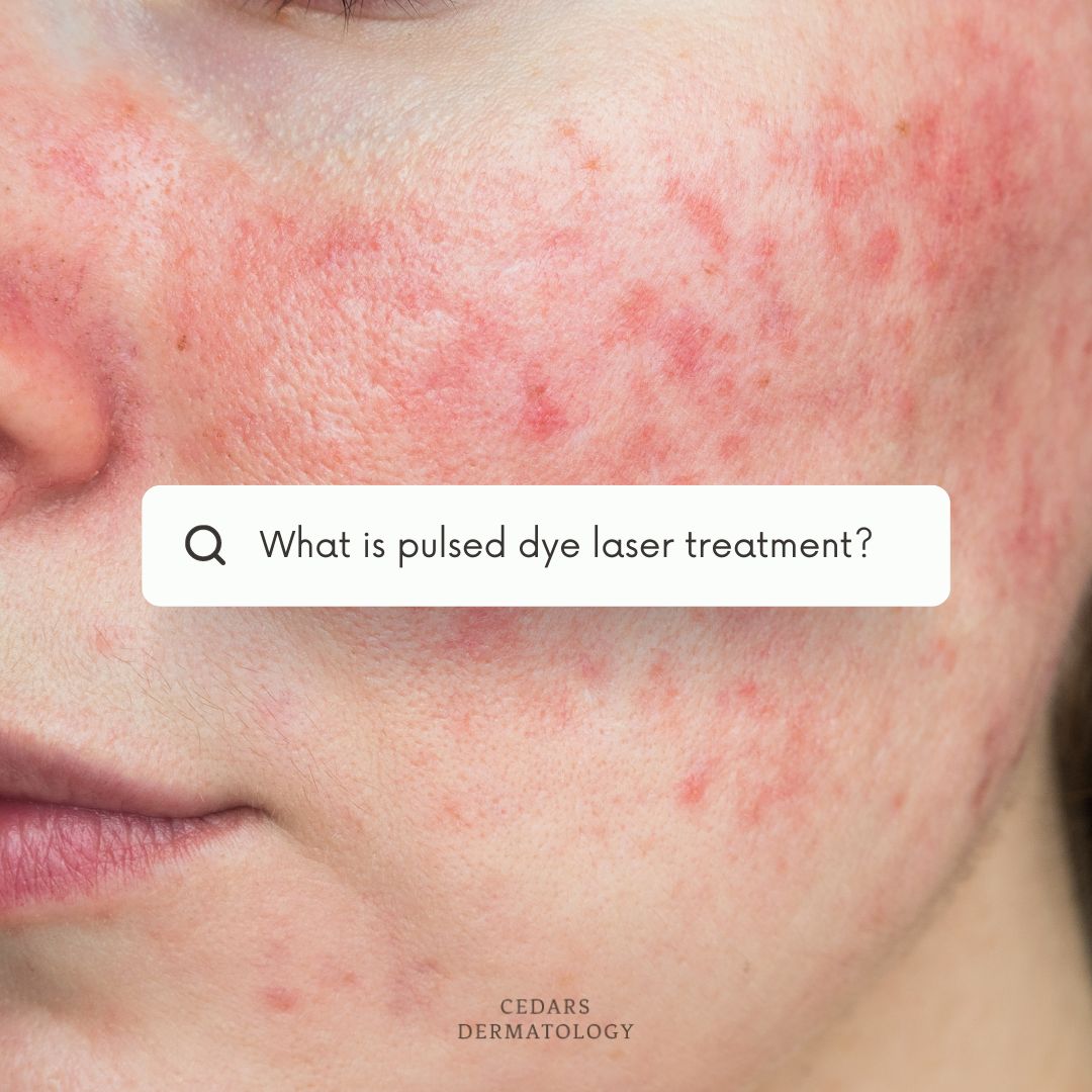 CedarsDerm's tweet photo. 𝐖𝐡𝐚𝐭 𝐢𝐬 𝐩𝐮𝐥𝐬𝐞𝐝 𝐝𝐲𝐞 𝐥𝐚𝐬𝐞𝐫 𝐭𝐫𝐞𝐚𝐭𝐦𝐞𝐧𝐭?

The Pulsed dye laser treatment is designed to lighten red-coloured skin marks, such as port wine stains, birth-marks on your skin or facial thread veins. 

Get in contact with us:
📞 0207 307 7467 https://t.co/S3TkPhIztR